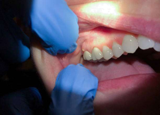 Best Emergency Wisdom Teeth Removal in Thompson, ND